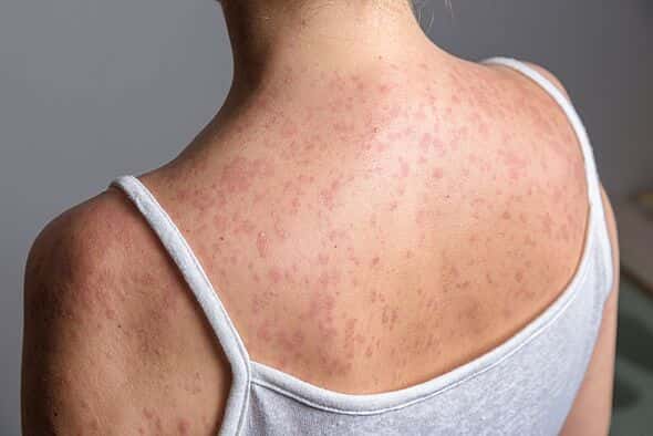 Measles Outbreak in the UK: Vaccination Urged as Virus Spreads