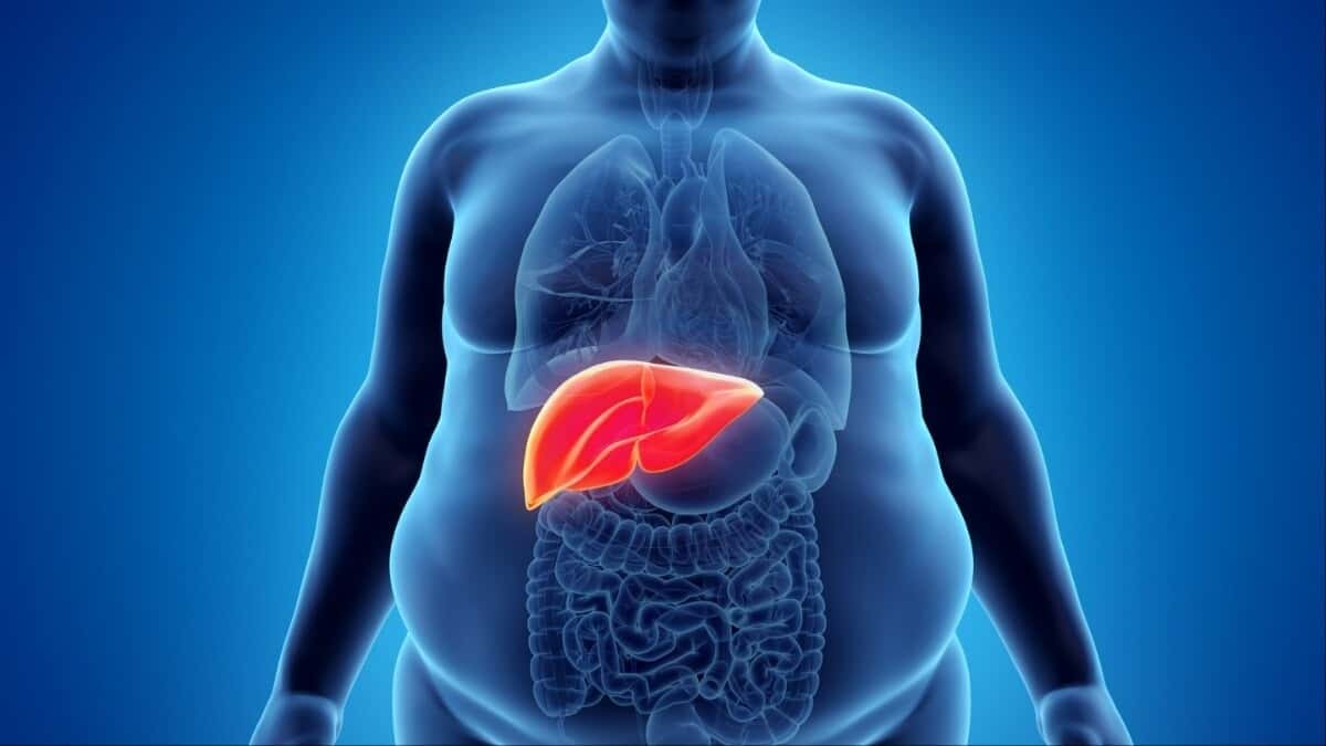 Understanding Fatty Liver Grade 1: Treatment Options Explained by Doctors