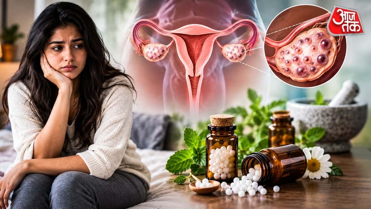 Homeopathy Treatment Helps Control PCOS, Doctor Explains Benefits